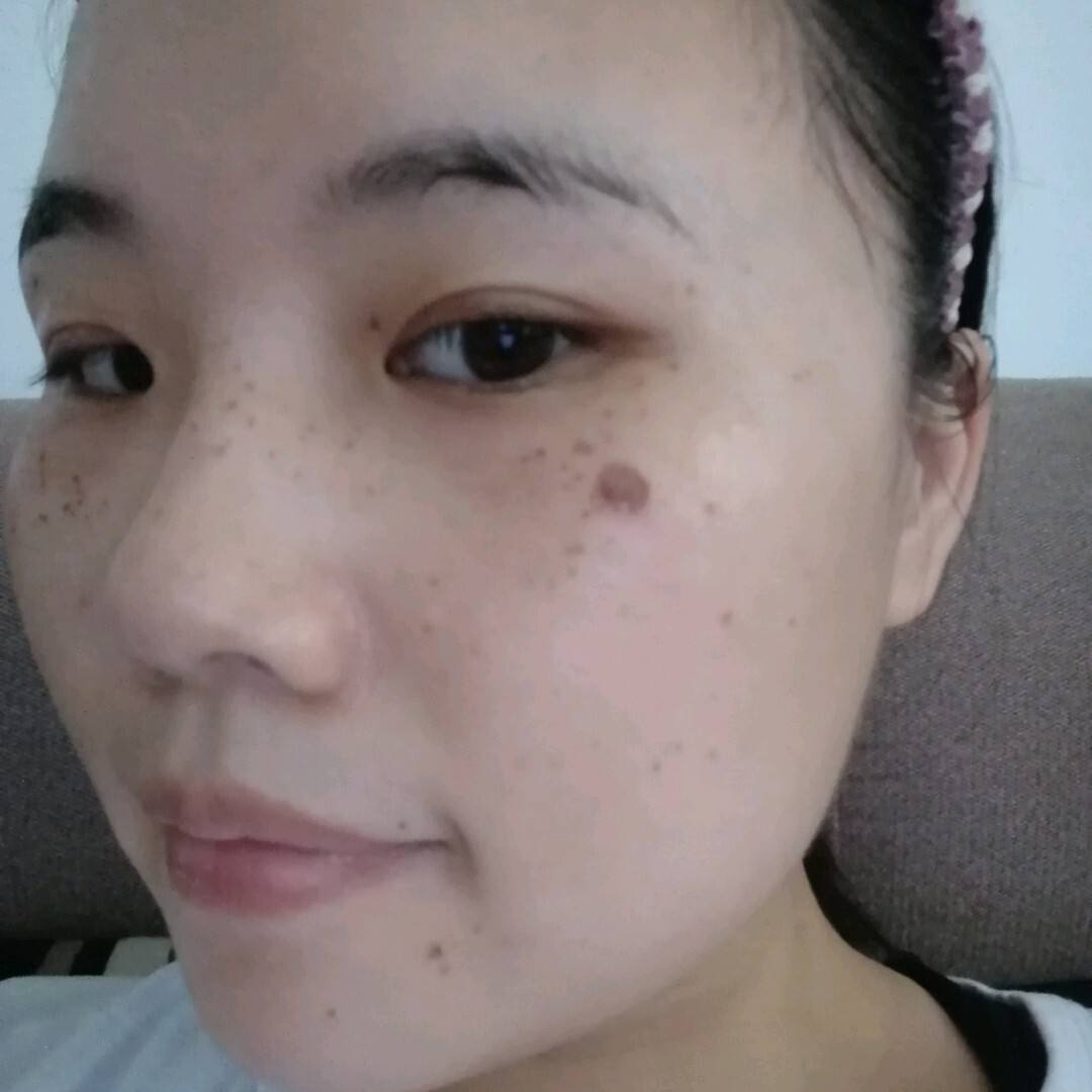 激光美容祛斑手术