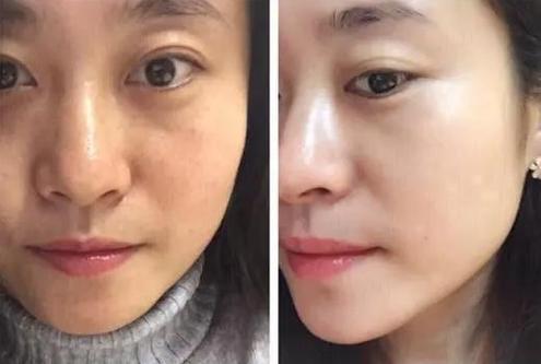 为什么吃祛斑胶囊要防晒
