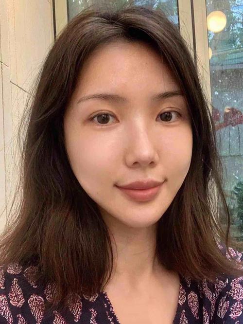 激光祛斑发红如何护理 激光祛斑发红如何护理