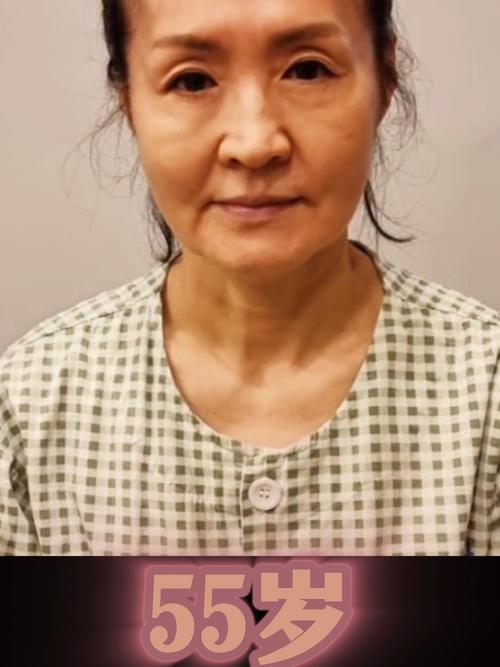 药膏祛斑还是激光祛斑好 药膏祛斑还是激光祛斑好