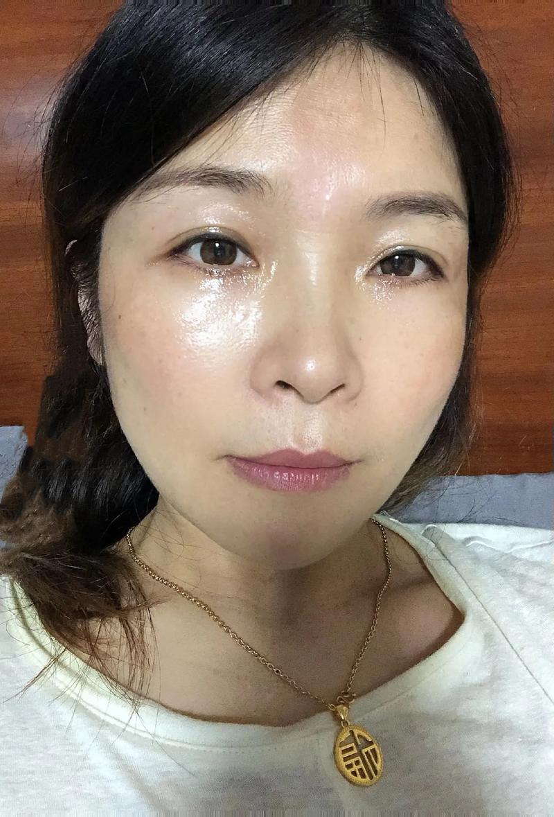 液氮祛斑之后脸特别红 液氮祛斑之后脸特别红